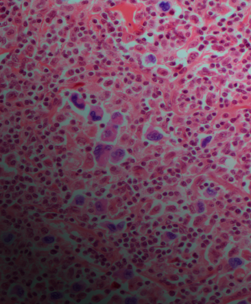 Illustration of cancerous cells in lymphoma